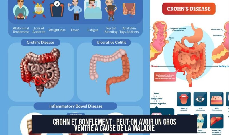 Crohn et Gonflement : Peut-on avoir un Gros Ventre à Cause de la Maladie