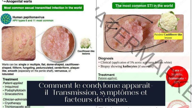 Comment le condylome apparaît-il Transmission, symptômes et facteurs de risque.