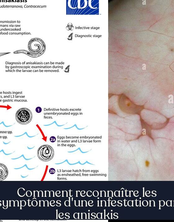 Comment reconnaître les symptômes d'une infestation par les anisakis