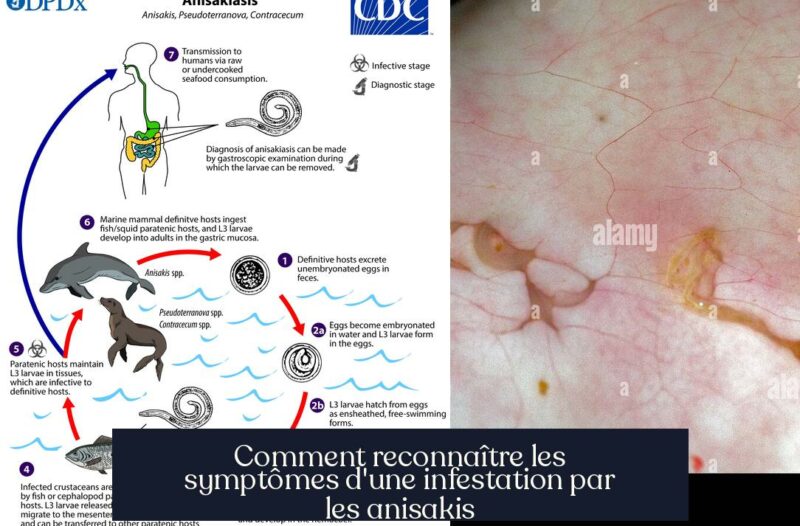 Comment reconnaître les symptômes d'une infestation par les anisakis