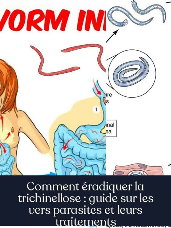 Comment éradiquer la trichinellose : guide sur les vers parasites et leurs traitements