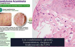 Les condylomes : gravité, transmission, risques et traitements du VPH