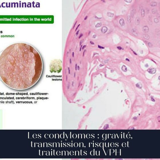 Les condylomes : gravité, transmission, risques et traitements du VPH