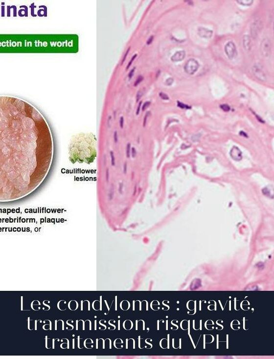 Les condylomes : gravité, transmission, risques et traitements du VPH