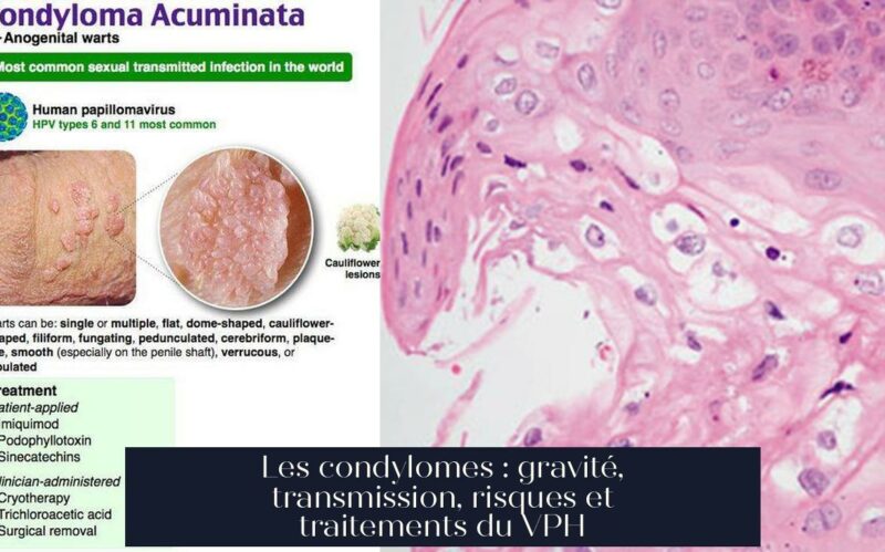 Les condylomes : gravité, transmission, risques et traitements du VPH