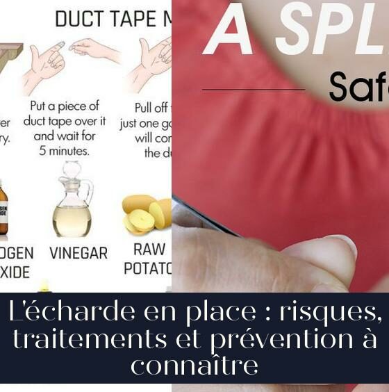 L'écharde en place : risques, traitements et prévention à connaître