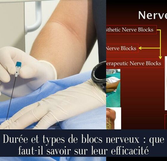 Durée et types de blocs nerveux : que faut-il savoir sur leur efficacité