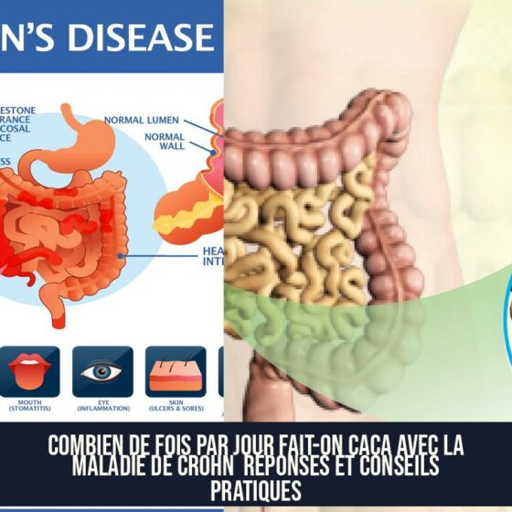 Combien de fois par jour fait-on caca avec la maladie de Crohn Réponses et conseils pratiques