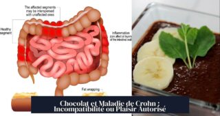 Chocolat et Maladie de Crohn : Incompatibilité ou Plaisir Autorisé