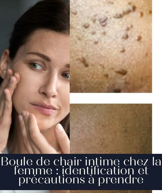 Boule de chair intime chez la femme : identification et précautions à prendre