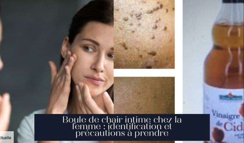 Boule de chair intime chez la femme : identification et précautions à prendre