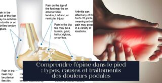 Comprendre l'épine dans le pied : types, causes et traitements des douleurs podales