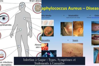 Infection à Coque : Types, Symptômes et Traitements à Connaître