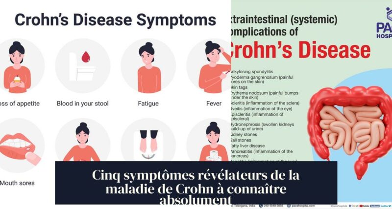 Cinq symptômes révélateurs de la maladie de Crohn à connaître absolument