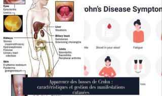 Apparence des bosses de Crohn : caractéristiques et gestion des manifestations cutanées