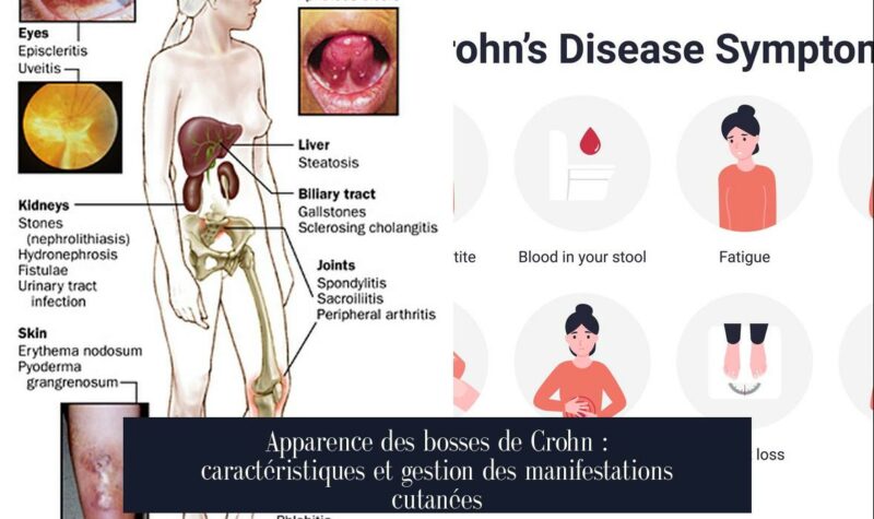 Apparence des bosses de Crohn : caractéristiques et gestion des manifestations cutanées