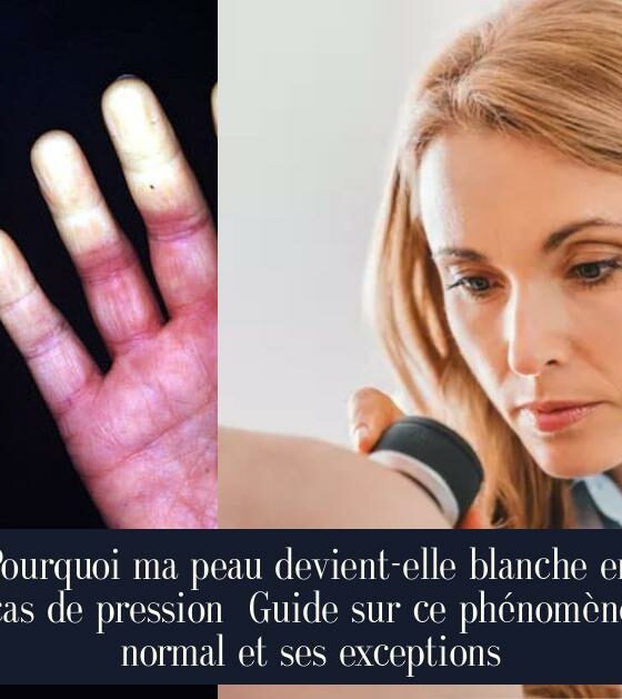 Pourquoi ma peau devient-elle blanche en cas de pression Guide sur ce phénomène normal et ses exceptions