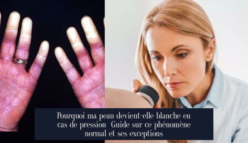 Pourquoi ma peau devient-elle blanche en cas de pression Guide sur ce phénomène normal et ses exceptions