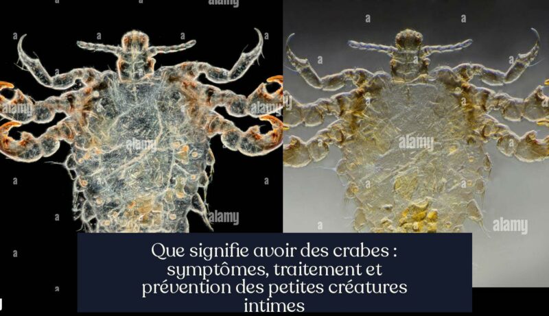 Que signifie avoir des crabes : symptômes, traitement et prévention des petites créatures intimes