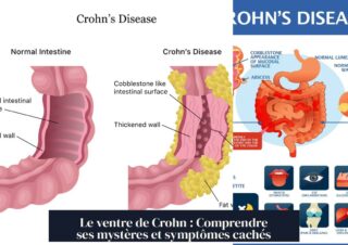 Le ventre de Crohn : Comprendre ses mystères et symptômes cachés