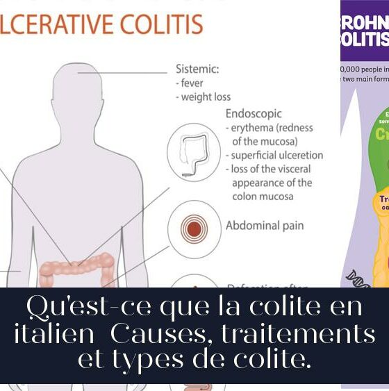 Qu'est-ce que la colite en italien Causes, traitements et types de colite.