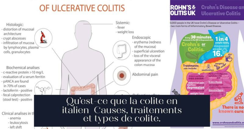 Qu'est-ce que la colite en italien Causes, traitements et types de colite.