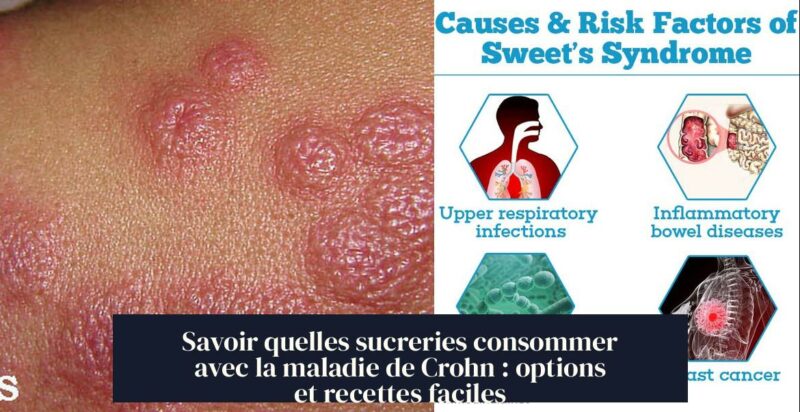 Savoir quelles sucreries consommer avec la maladie de Crohn : options et recettes faciles